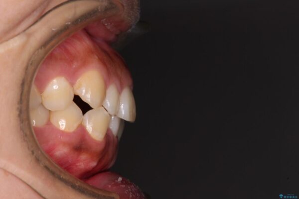 【モニター】カリエール・ディスタライザーを併用した八重歯のインビザライン矯正 治療前画像