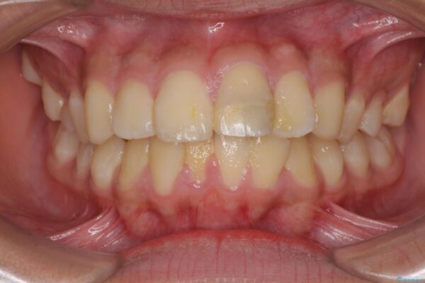 膨らんだ口元　ワイヤー装置での抜歯矯正 治療前画像