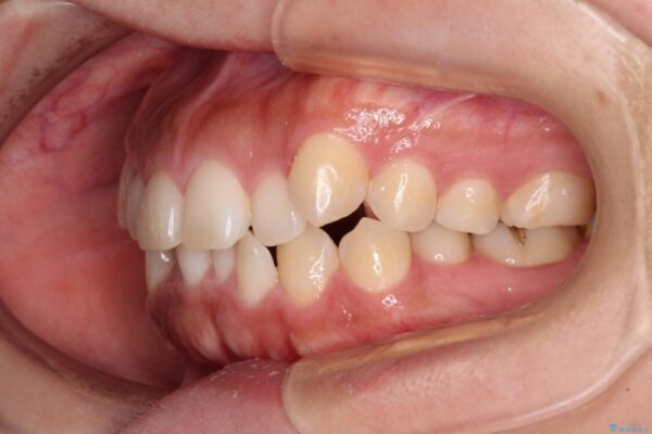 【モニター】カリエール・ディスタライザーを併用した八重歯のインビザライン矯正 治療前画像