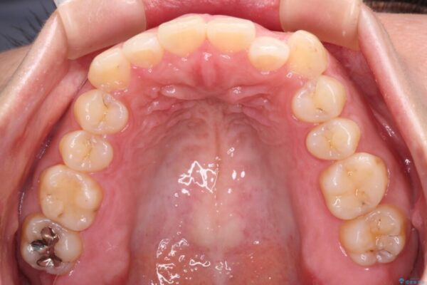 【モニター】カリエール・ディスタライザーを併用した八重歯のインビザライン矯正 治療前画像