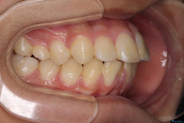 膨らんだ口元　ワイヤー装置での抜歯矯正 治療前画像