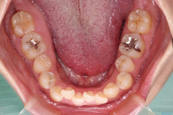 【モニター】カリエール・ディスタライザーを併用した八重歯のインビザライン矯正 治療前画像