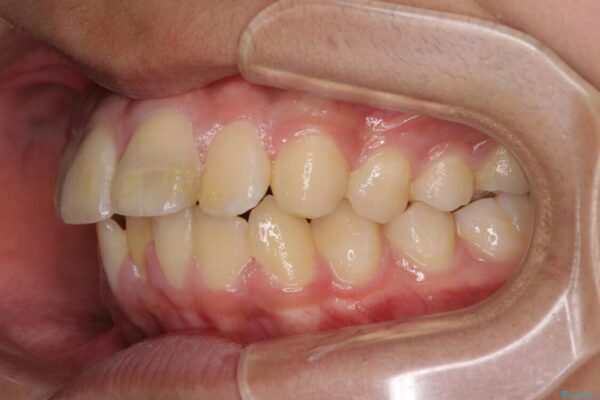 膨らんだ口元　ワイヤー装置での抜歯矯正 治療前画像