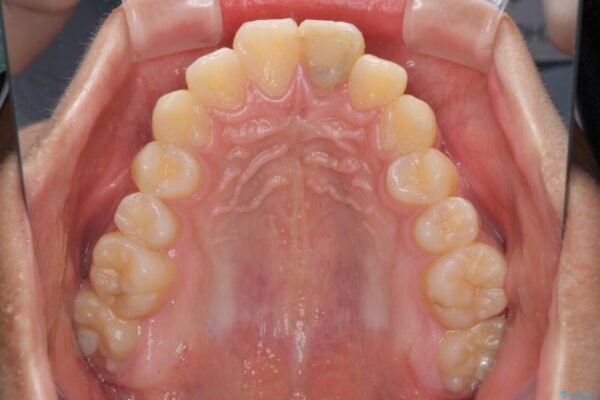 膨らんだ口元　ワイヤー装置での抜歯矯正 治療前画像
