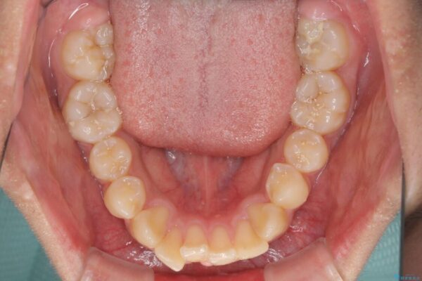 膨らんだ口元　ワイヤー装置での抜歯矯正 治療前画像