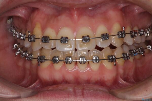 左右の八重歯が気になる　ワイヤー装置での咬み合わせ改善 治療途中画像