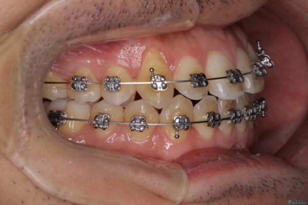 左右の八重歯が気になる　ワイヤー装置での咬み合わせ改善 治療途中画像