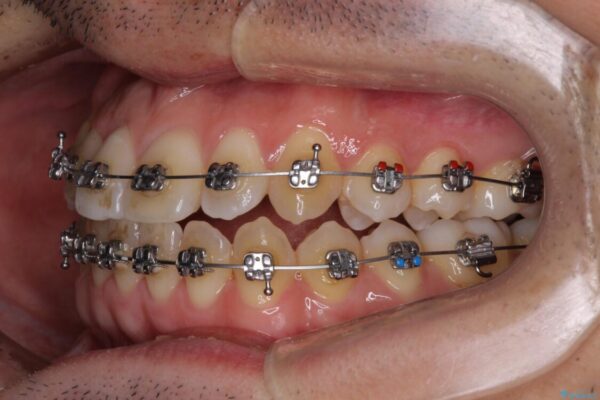 左右の八重歯が気になる　ワイヤー装置での咬み合わせ改善 治療途中画像