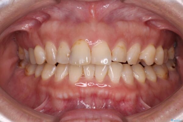 【モニター】飛び出た前歯を整えたい　ワイヤー矯正治療 治療前画像