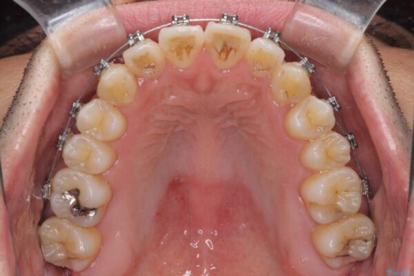左右の八重歯が気になる　ワイヤー装置での咬み合わせ改善 治療途中画像