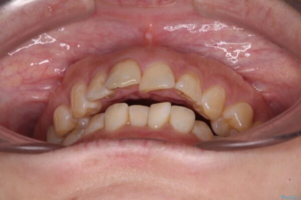 【モニター】飛び出た前歯を整えたい　ワイヤー矯正治療 治療前画像