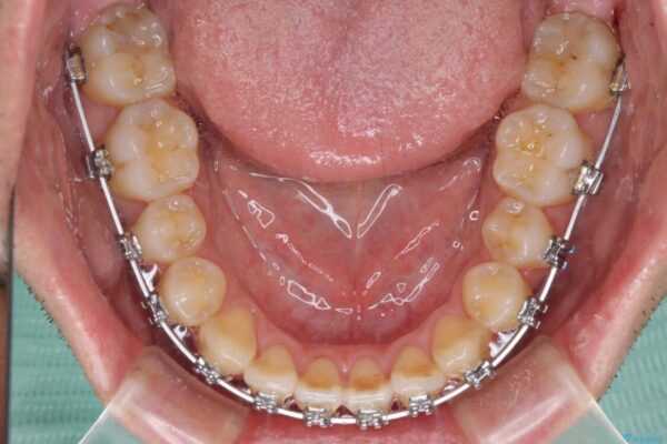 左右の八重歯が気になる　ワイヤー装置での咬み合わせ改善 治療途中画像