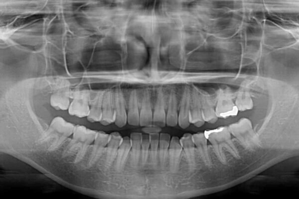 【モニター】下顎前歯のデコボコをインビザラインできれいに 治療前画像