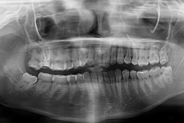 治療途中の奥歯と矯正治療の後戻り　インビザライン・ライトによる矯正治療 治療前画像