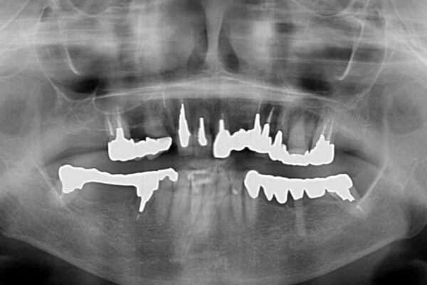 前歯をきれいにしたい　インプラントや部分矯正を用いた総合歯科治療 治療前画像