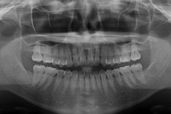 【モニター】前歯のデコボコをインビザラインで改善 治療前画像