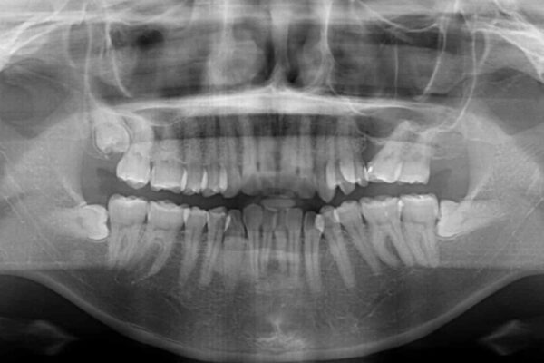 インビザラインによる矯正治療と奥歯のインプラント治療 ビフォー