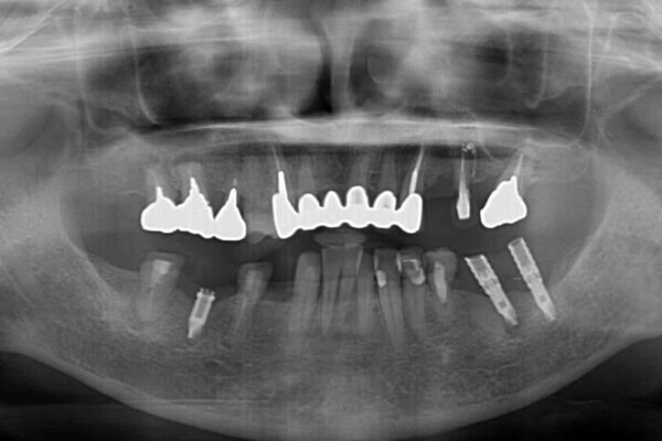 放置したインプラントとインビザライン　全顎リカバリー治療 治療前画像