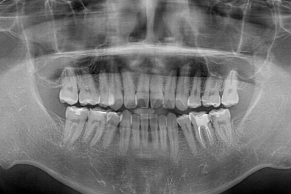 後戻りでデコボコの前歯　インビザライン矯正治療 治療前画像