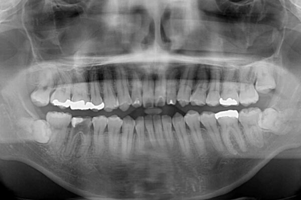 口元の突出感を改善!目立ちにくいワイヤー矯正で自信を持てる自然な横顔に 治療前画像