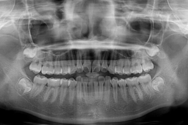 インビザラインは使える自信がない　ワイヤー装置にて矯正治療 治療前画像