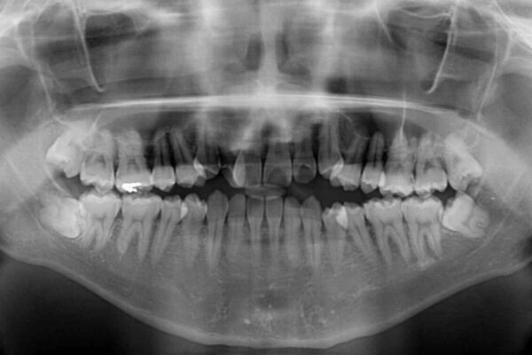 左右の八重歯が気になる　ワイヤー装置での咬み合わせ改善 治療前画像