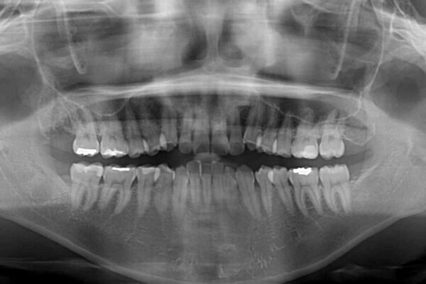 【モニター】カリエール・ディスタライザーを併用した八重歯のインビザライン矯正 治療前画像