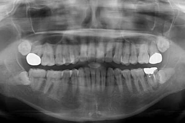むし歯だらけの前歯をオールセラミッククラウンできれいに 治療前画像