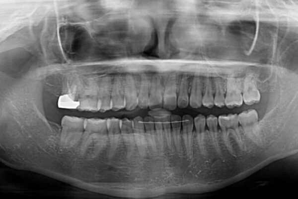 治療途中の奥歯と矯正治療の後戻り　インビザライン・ライトによる矯正治療 治療後画像
