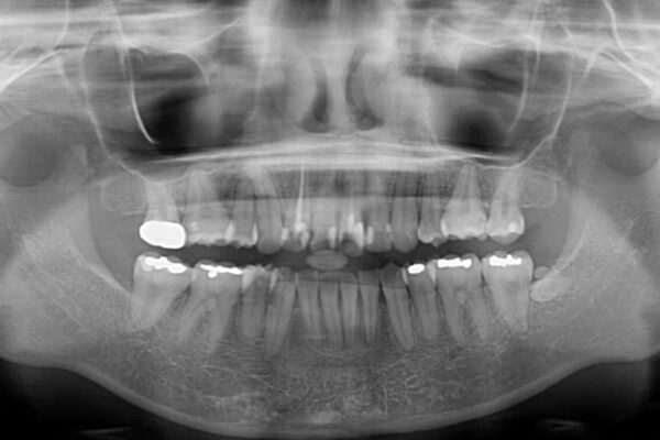 デコボコと深い咬み合わせ　ワイヤー装置での抜歯矯正 治療後画像