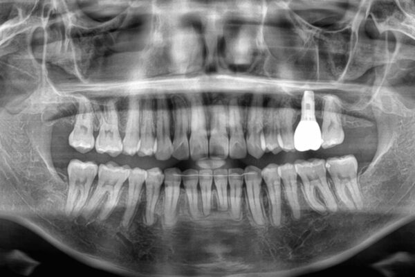 インビザラインによる矯正治療と奥歯のインプラント治療 アフター