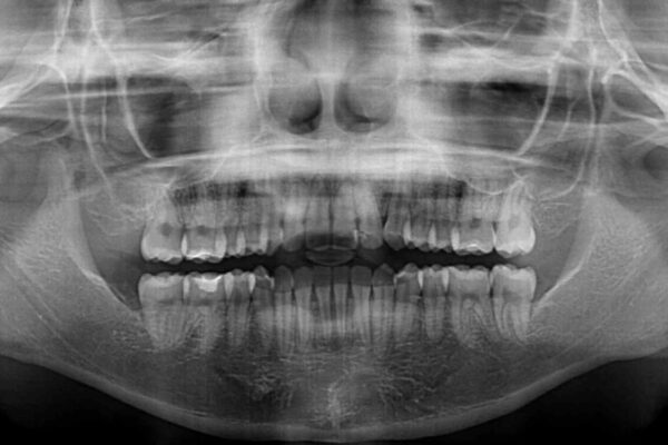 【モニター】短期間で終わりたい　ワイヤー装置での非抜歯矯正 治療後画像