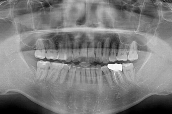 後戻りでデコボコの前歯　インビザライン矯正治療 治療後画像