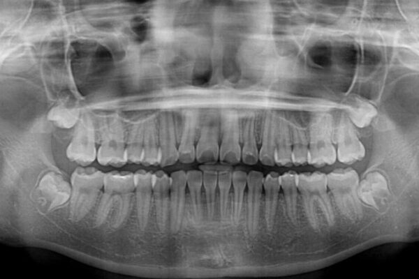 インビザラインは使える自信がない　ワイヤー装置にて矯正治療 治療後画像