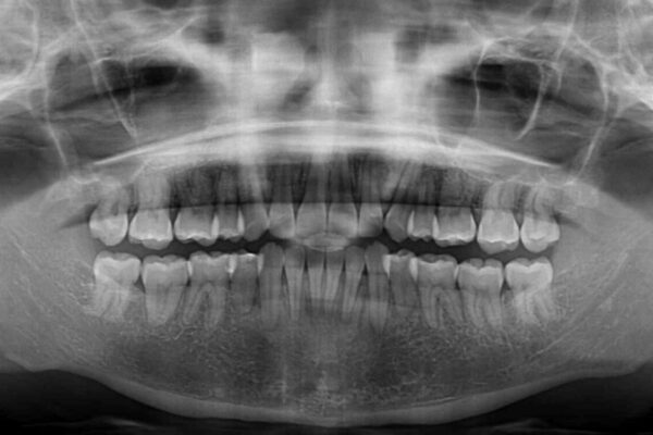 抜歯矯正で唇を閉じやすく　目立たないワイヤー装置 治療途中画像