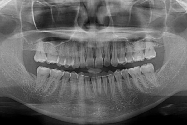 【モニター】前歯のデコボコをインビザラインで改善 治療後画像