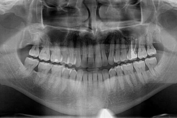 前歯でものを噛みきりたい　目立たない装置でのワイヤー矯正 治療後画像