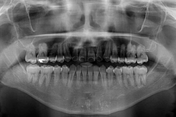左右の八重歯が気になる　ワイヤー装置での咬み合わせ改善 治療後画像