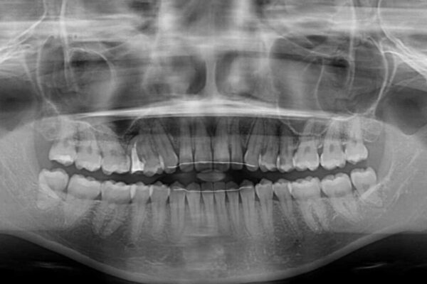 隙間だらけの歯列　インビザラインで改善 治療後画像