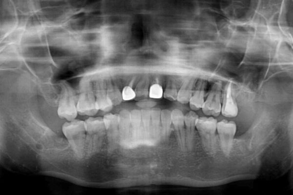 虫歯治療ついでに歯並びの後戻りを改善　インビザラインによる矯正治療 治療前画像