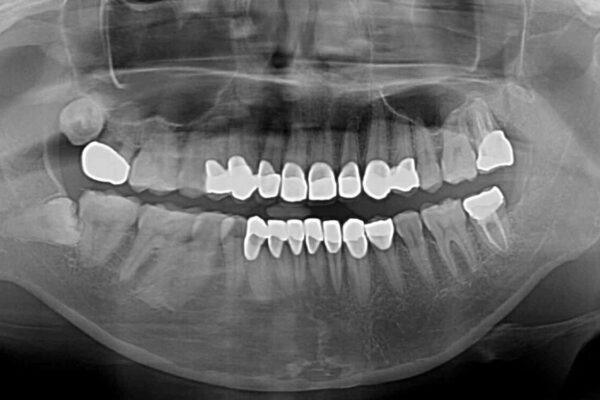 むし歯だらけの前歯をオールセラミッククラウンできれいに 治療後画像