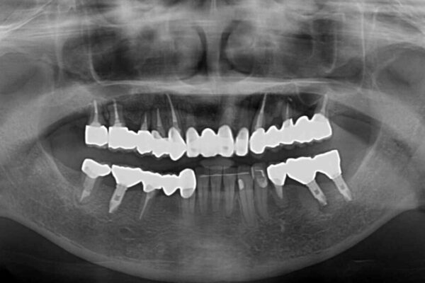 放置したインプラントとインビザライン　全顎リカバリー治療 治療後画像