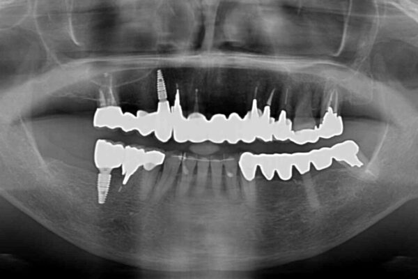 前歯をきれいにしたい　インプラントや部分矯正を用いた総合歯科治療 治療後画像