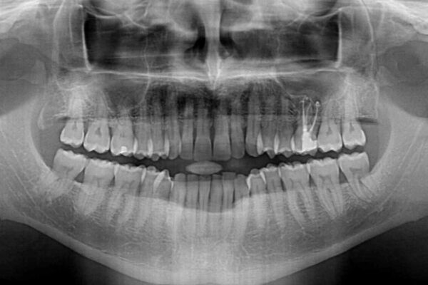 前歯でものを噛みきりたい　目立たない装置でのワイヤー矯正 治療前画像