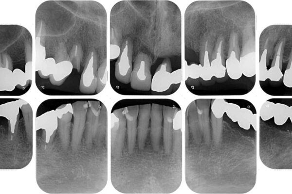 前歯をきれいにしたい　インプラントや部分矯正を用いた総合歯科治療 治療前画像