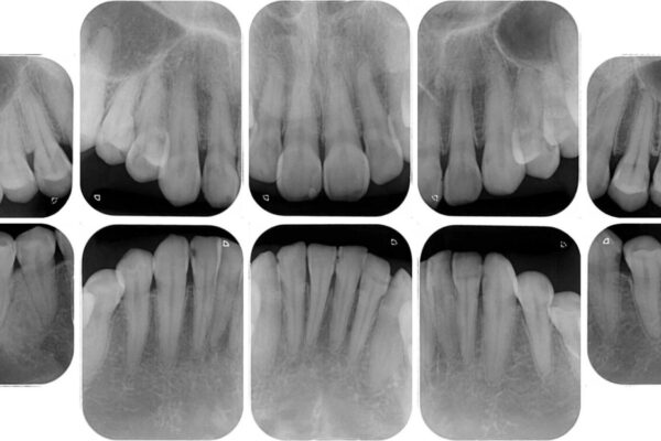むし歯だらけの前歯をオールセラミッククラウンできれいに 治療前画像