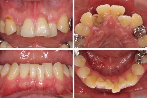 割れてしまった奥歯とデコボコの前歯　矯正治療とインプラント治療 治療前画像