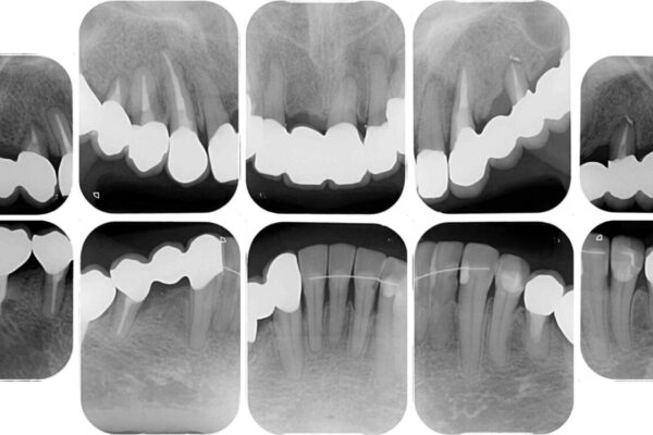 放置したインプラントとインビザライン　全顎リカバリー治療 治療後画像
