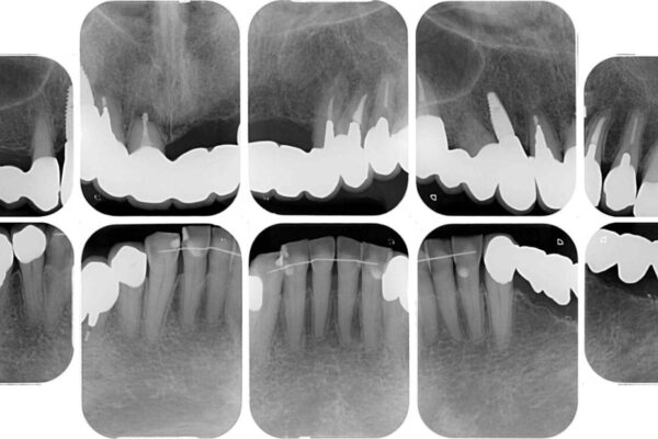 前歯をきれいにしたい　インプラントや部分矯正を用いた総合歯科治療 治療後画像