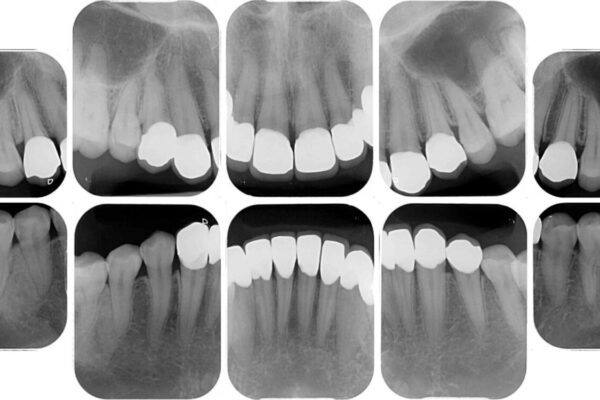 むし歯だらけの前歯をオールセラミッククラウンできれいに 治療後画像